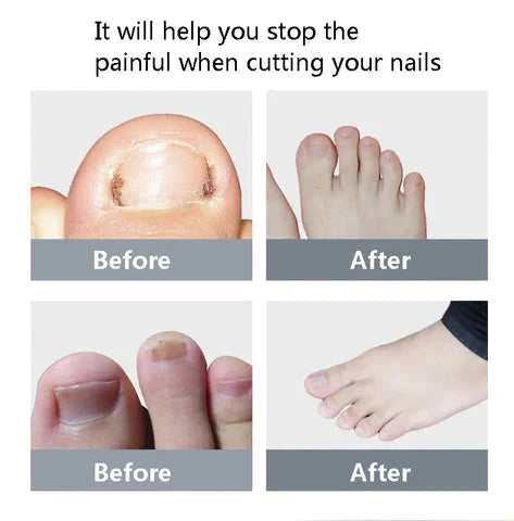 NailCare Pro™ - Nail Cutter
